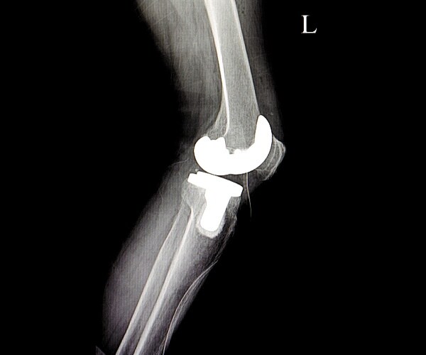 Study: Knee, Hip Replacements Reduce Fall Risk