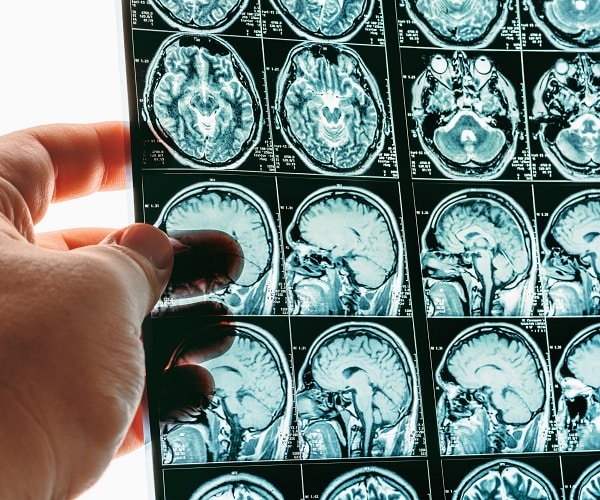 doctor holds mri brain scan