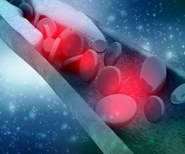 illustration of clog heart arteries
