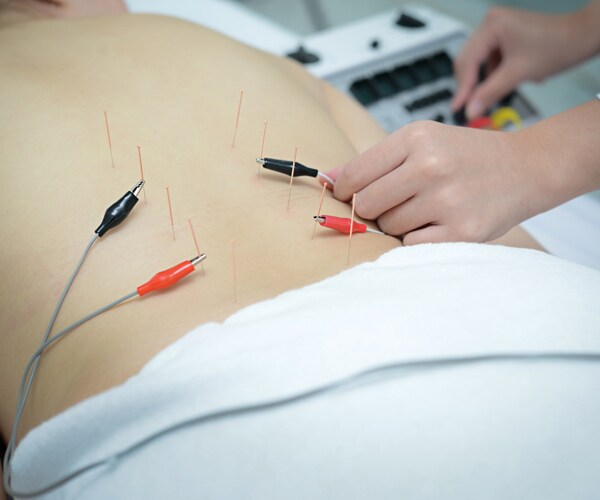 a patient having electroacupuncture therapy on the back