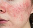 FDA Approves New Drug to Treat Rosacea