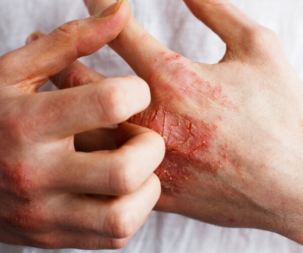 psoriasis on hands