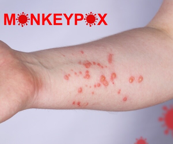 closeup of arm with monkeypox lesions, monkeypox spelled out in red