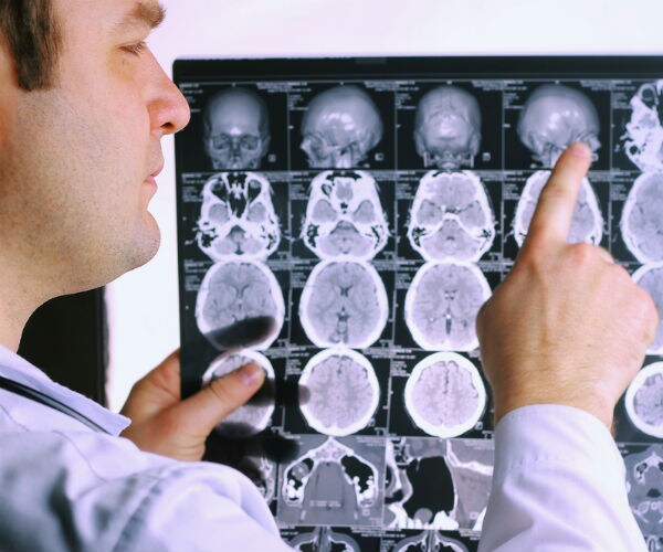Study Finds Some Patients With A-Fib Have Hidden Brain Damage