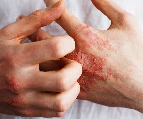 close-up of person itching eczema on their hands