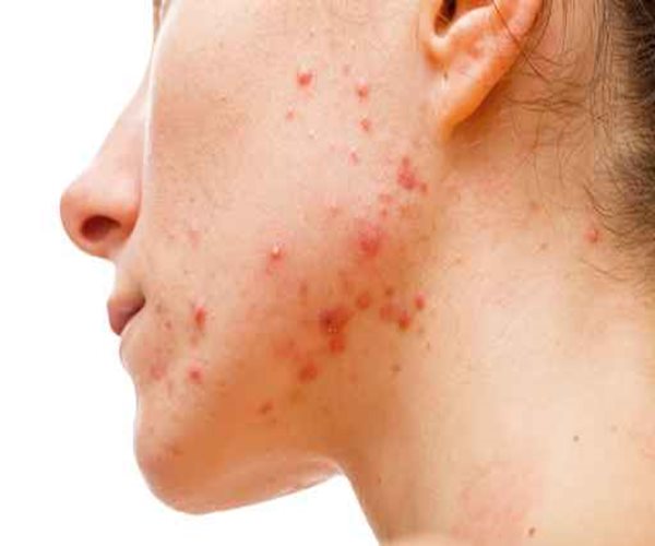 First Non-Prescription Acne Retinoid Drug OK'd