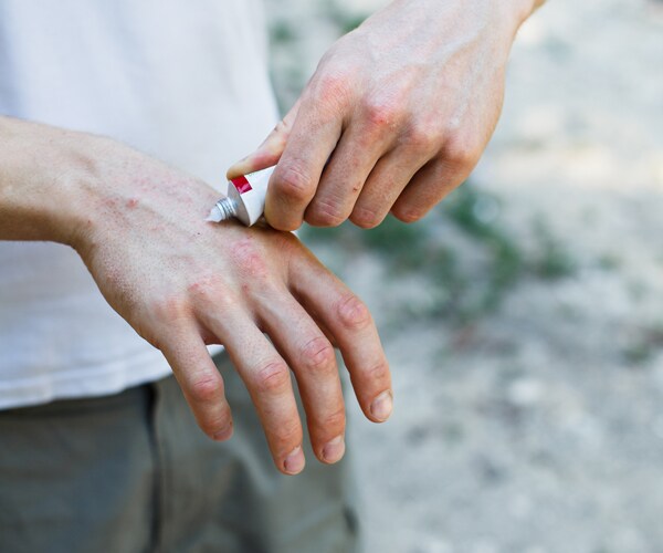 a man applying cream on a skin rash