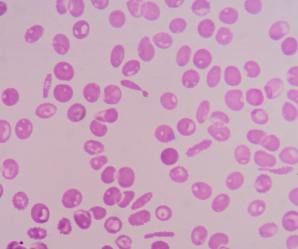 microscopic view of abnormal red blood cells due to thalassemia