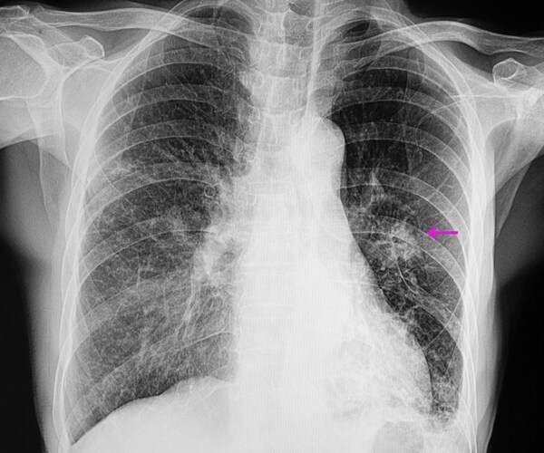 a chest x-ray showing pneumonia