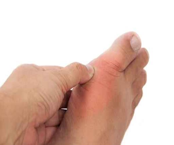 Steroids May Be Safe, Effective Gout Treatment