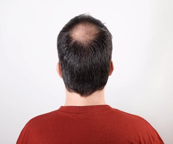 Geneticists Get to the Roots of Hair Loss in Men