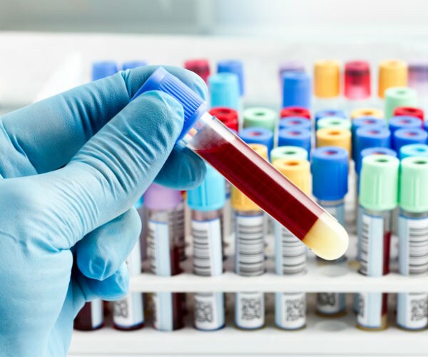 Breakthrough First Blood Test for Melanoma Developed