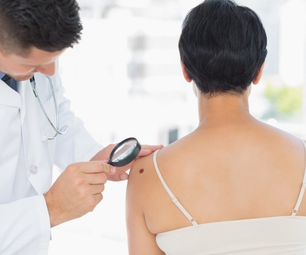 doctor looking at melanoma with magnifying glass on woman's back