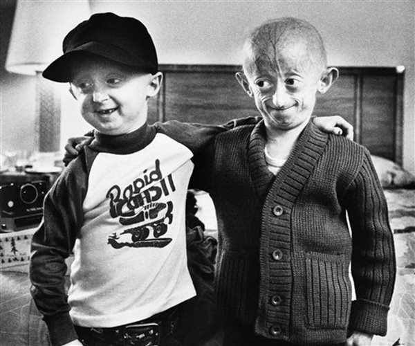 Drug Gives Hope to Kids With Rapid Aging Disease 