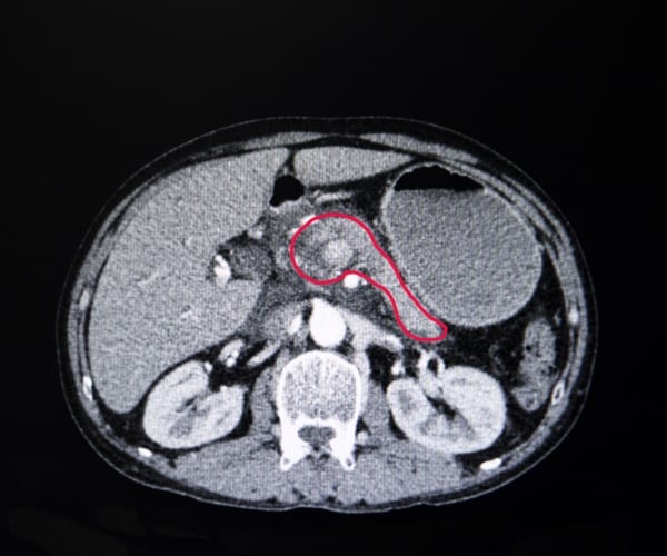 image highlighting cancer of the pancreas