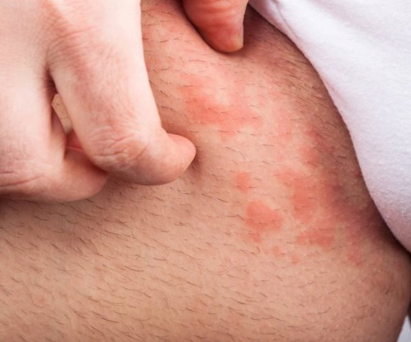 Got Hives? Skip the Steroids