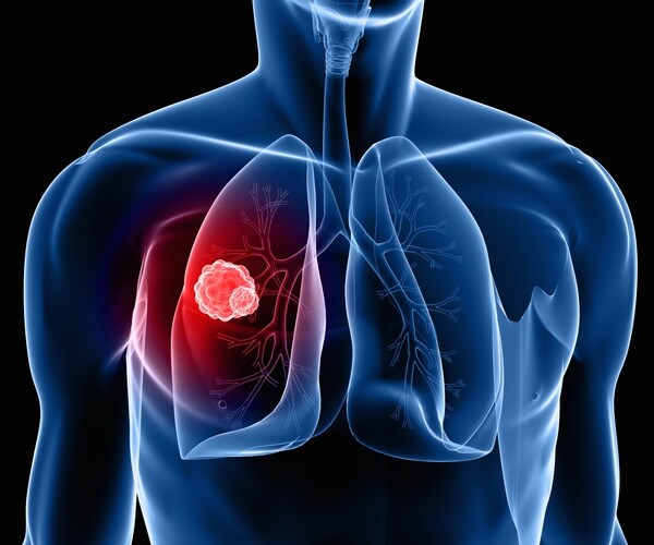 Sleep Apnea Makes Lung Cancer Deadly