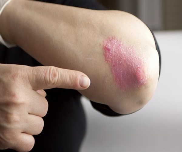 Severe Psoriasis Tied to Earlier Death