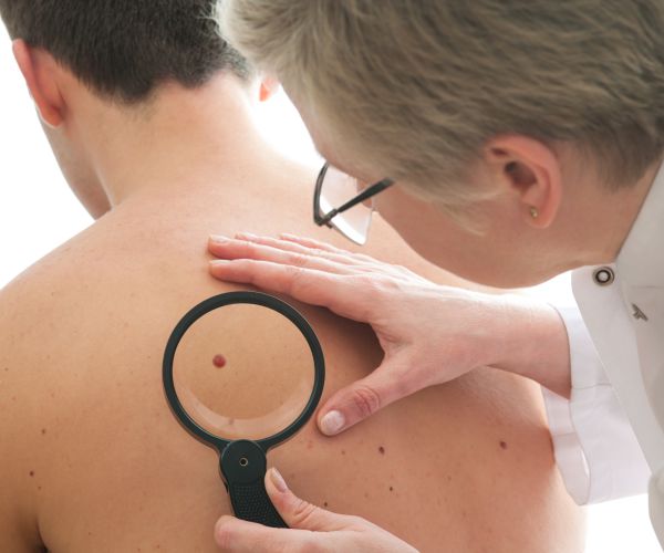 AI System's Skin Cancer Diagnoses Just as Accurate as Dermatologists