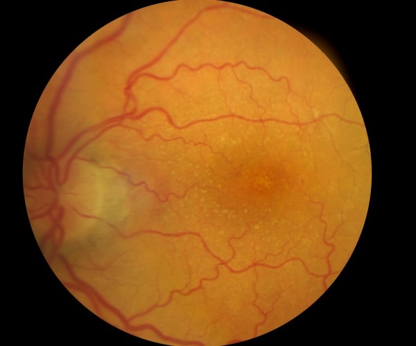 close-up of an eye with macular degeneration