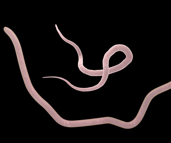14 Roundworms Pulled From Woman's Bile Duct by Surgeons