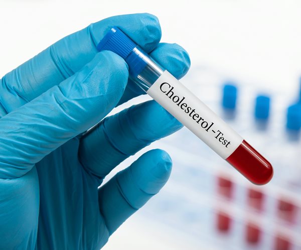 Cholesterol Levels in US Dropping Thanks to Changed Recommendations