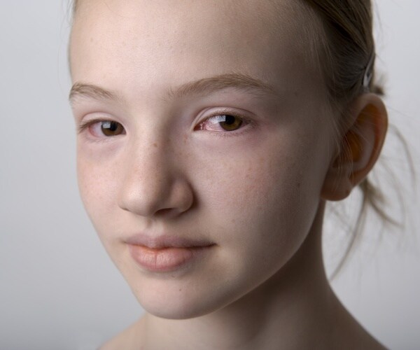 young girl with red eyes/pink eye