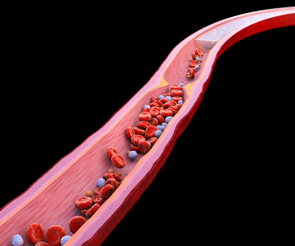 a graphic showing a blocked blood vessel