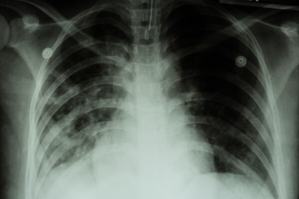 Drug-Resistant TB Patient Traveled to 3 US States Before Hospitalization