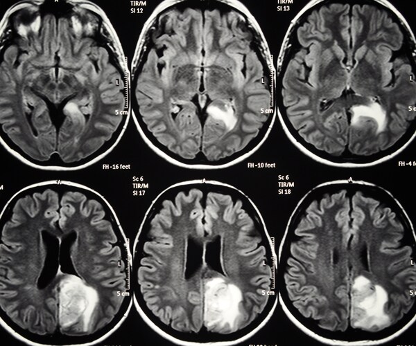Brain scans showing a cancerous tumor