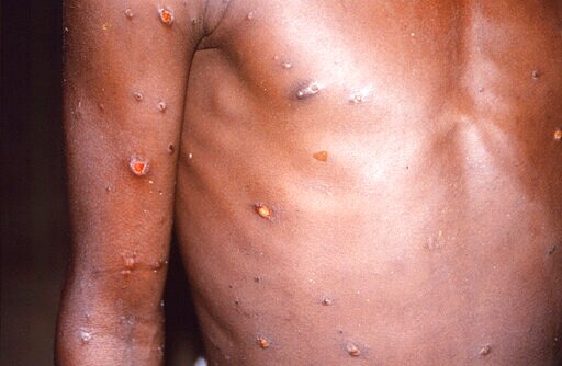 Monkeypox Outbreak Needs a United Response, Says WHO Africa