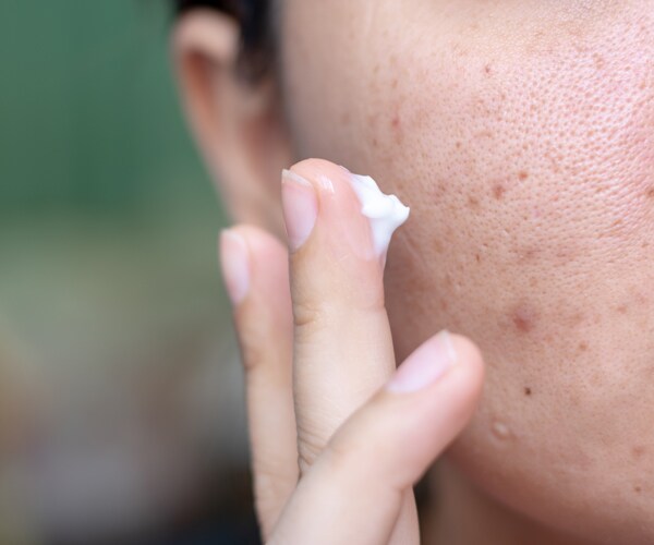 a woman applying facial cream to treat acne