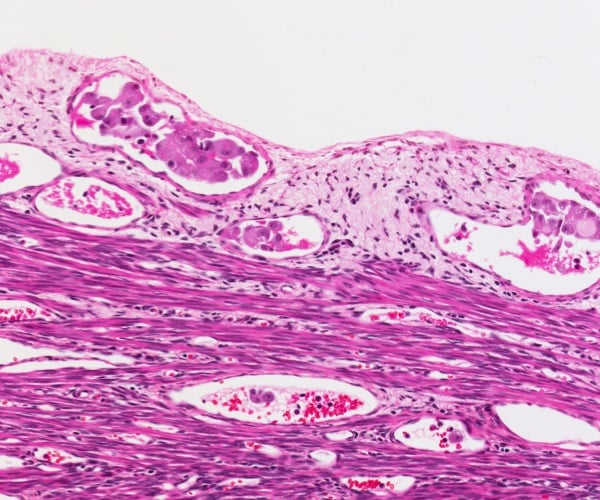 illustration of metastatic cancer of uterine lining