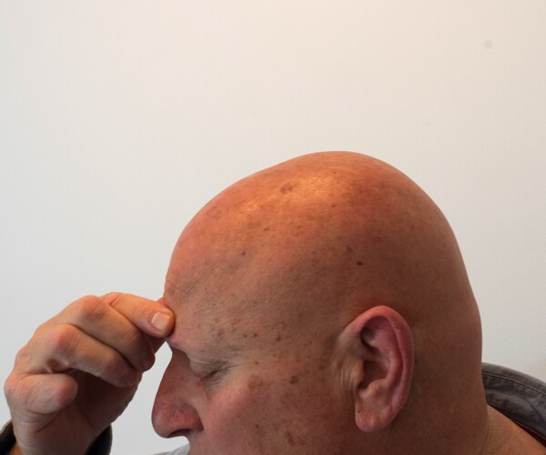 Instagram Photo Leads to Skin Cancer Diagnosis