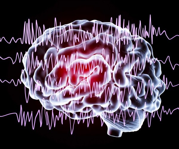 illustration of brain during a seizure