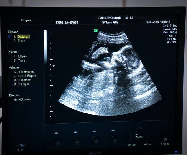 Study Suggests Fetal Coronavirus Infection Is Possible 