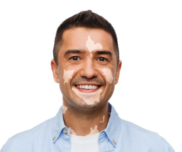 man smiling at camera, has vitiligo on face and neck