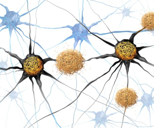 microscopic view of tau tangles in brain