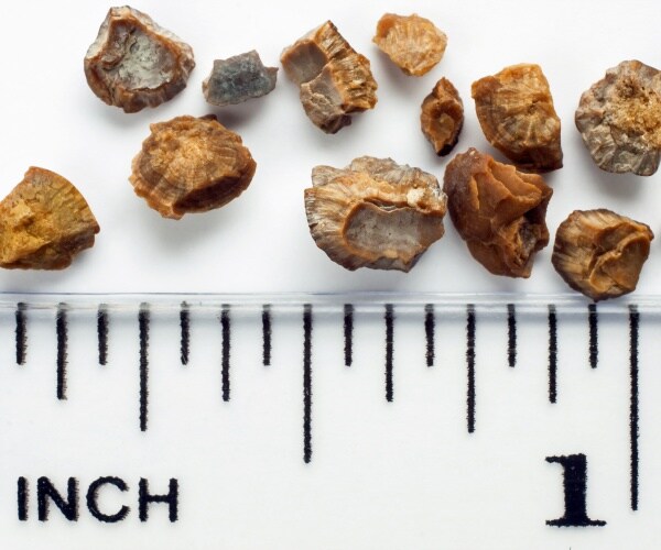 kidney stones on table next to measuring tape