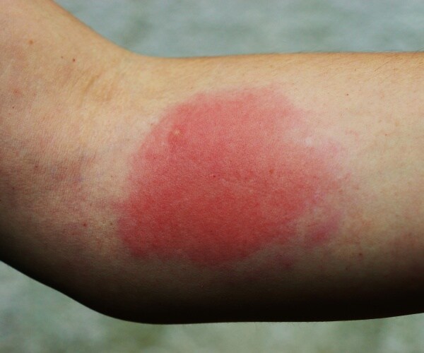 an arm with large circle of red skin showing an allergic reaction to a wasp sting