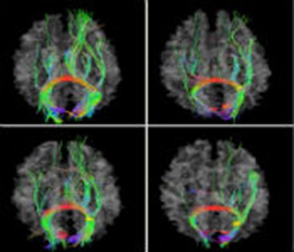 New Wave in Tech: Hacking the Brain
