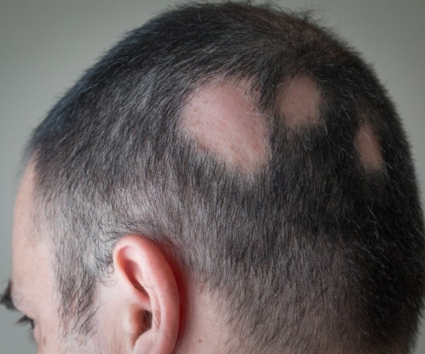 man's head with bald spots due to alopecia