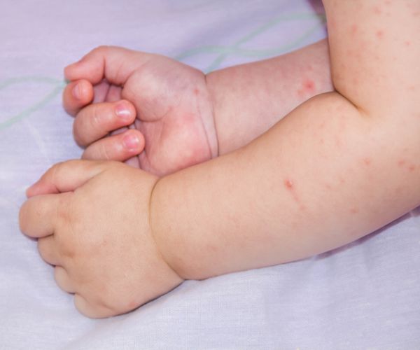 Nearly 1 in 2 US Kids Has a Food Allergy