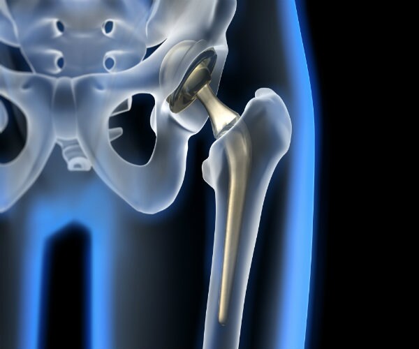 Hip Fractures on the Rise in Older Women