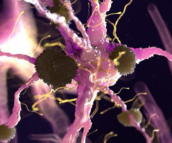 microscopic view of tau tangles in brain