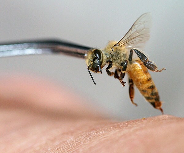 Bee Sting Acupuncture Death: Woman Has Fatal Allergic Reaction