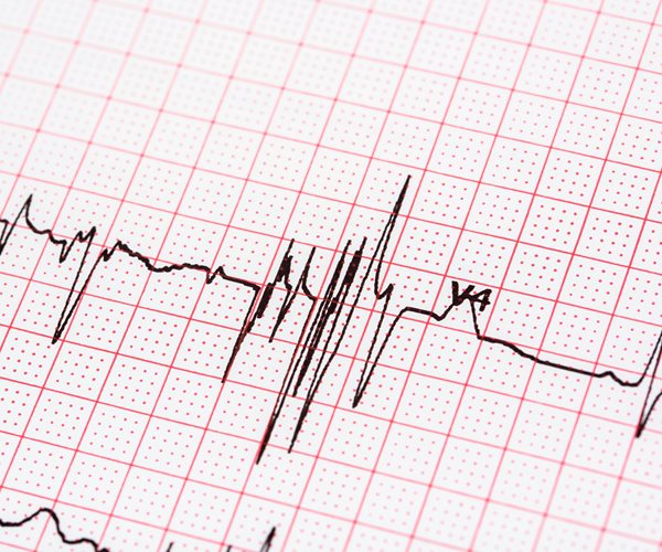 an electrocardiogram display