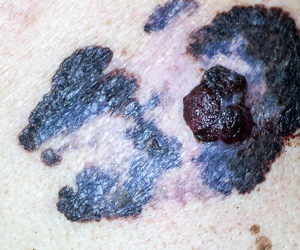 Melanoma Diagnosis Accuracy Improves With Specialist