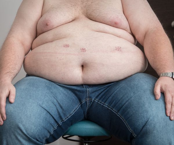 Weight-Loss Surgery Puts Type 2 Diabetes Into Remission