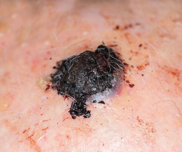 melanoma on skin